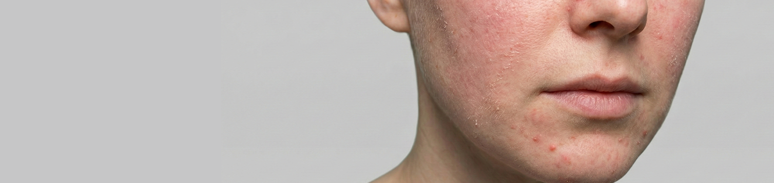 Sensitive Skin