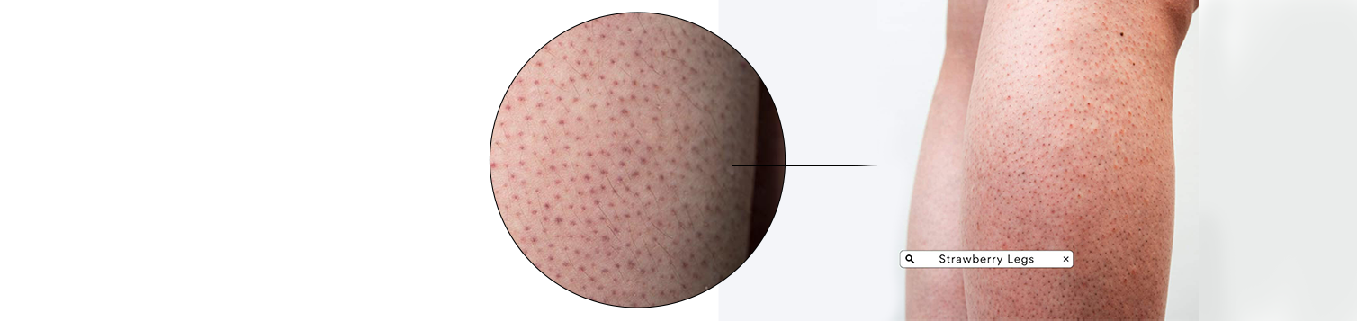 Strawberry Bumpy Skin