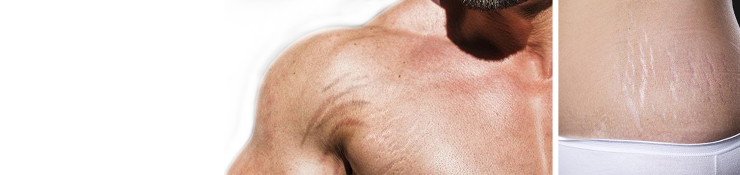 Stretch Marks