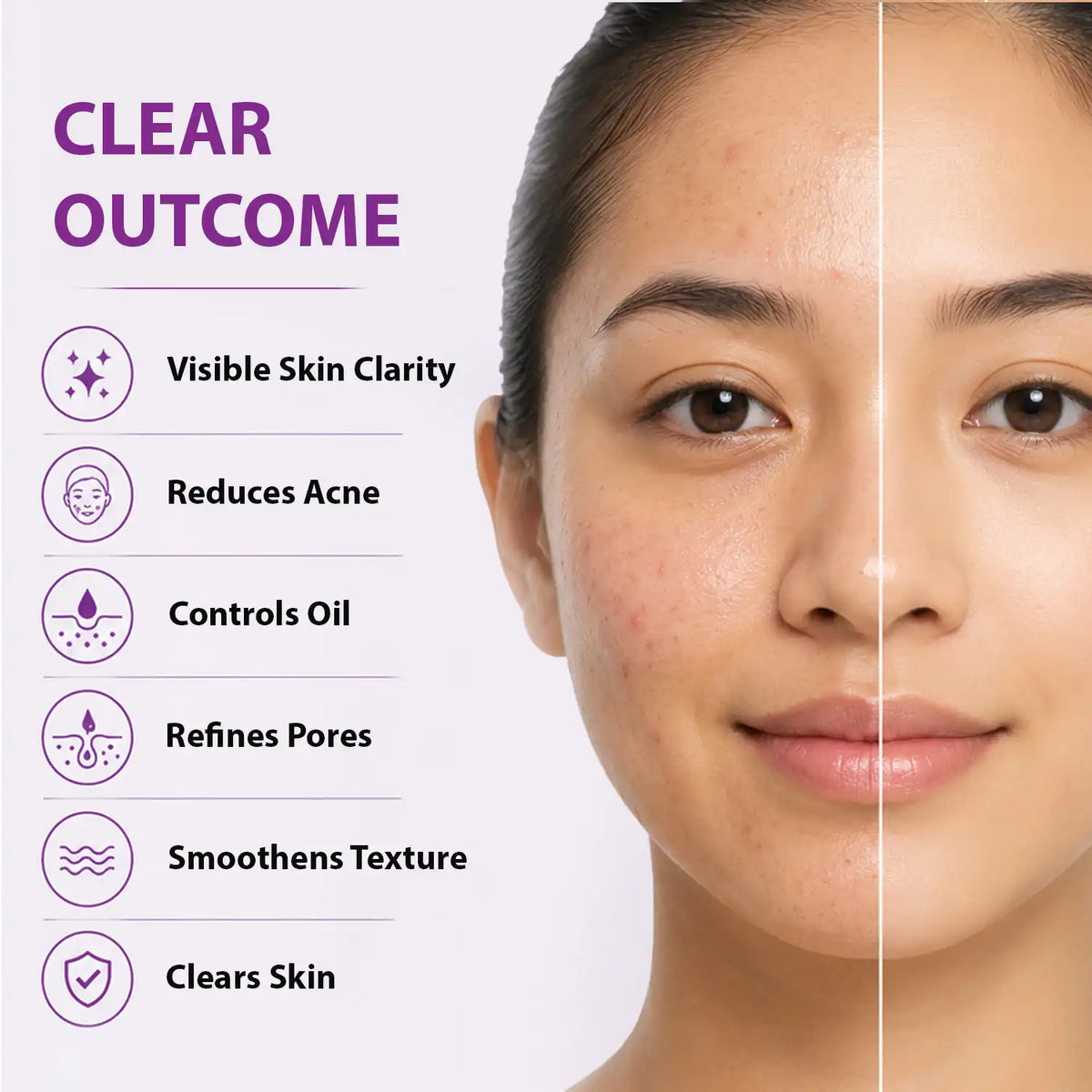 Salicylic Acid Serum for Acne-Prone Skin | Dermistry